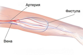 Фистула для гемодиализа