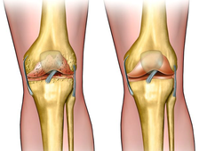 Лечение артроза коленного сустава