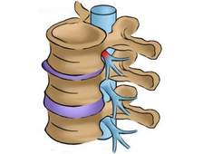 Лечение остеохондроза поясничного отдела