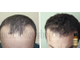Рост и укрепление волос: Дермаштамп - 0,5 мм (derma stamp) титановые иглы с серебряным напылением. Для головы и лица + Средство для роста волос "Andrea" (20 ml) - 100% натуральные ингредиенты. Для быстрого роста, крепости и эластичности