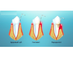 Пародонтология (лечение десен)