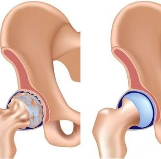Лечение артроза тазобедренного сустава