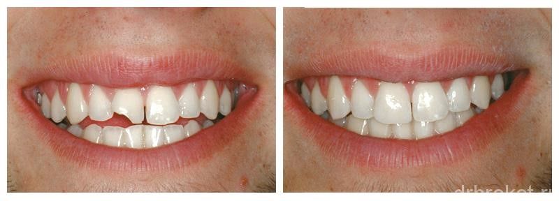 До и после художественной реставрации зубов