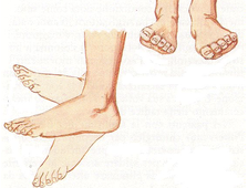 Лечение артрита стопы :: голеностопного сустава