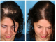Дермаштамп - 0,5 мм (derma stamp) титановые иглы с серебряным напылением. Для головы и лица