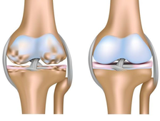 Лечение артрита коленных суставов