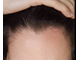Пена Rogaine Регейн Миноксидил 5% средство для роста волос для женщин - #1 В США