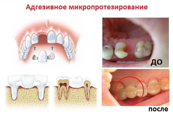 Адгезивное микропротезирование зубов