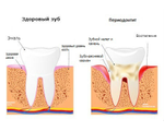 Пародонтология (лечение десен)