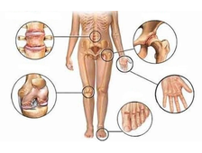Лечение артрита