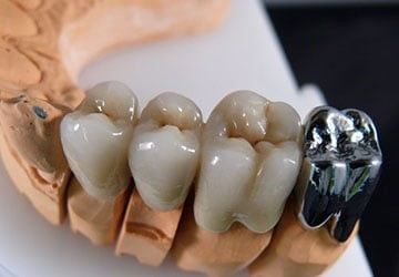 Несъёмный зубной протез