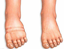 Лечение отёков ног :: стоп, коленей, щиколоток