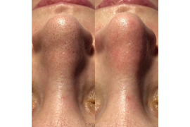 Атравматическая чистка лица Flax Peel Face