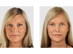 Омоложение, эластичность и упругость кожи: Мезороллер (540 игл) + QYF-6 peptides (Шесть пептидов) - (10ml) + Альгинатная Маска для лица Collagen