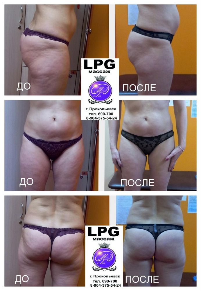 Отзыв lpg массаж по телу Отзыв lpg массаж по телу