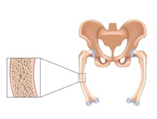 Лечение остеомаляции костей