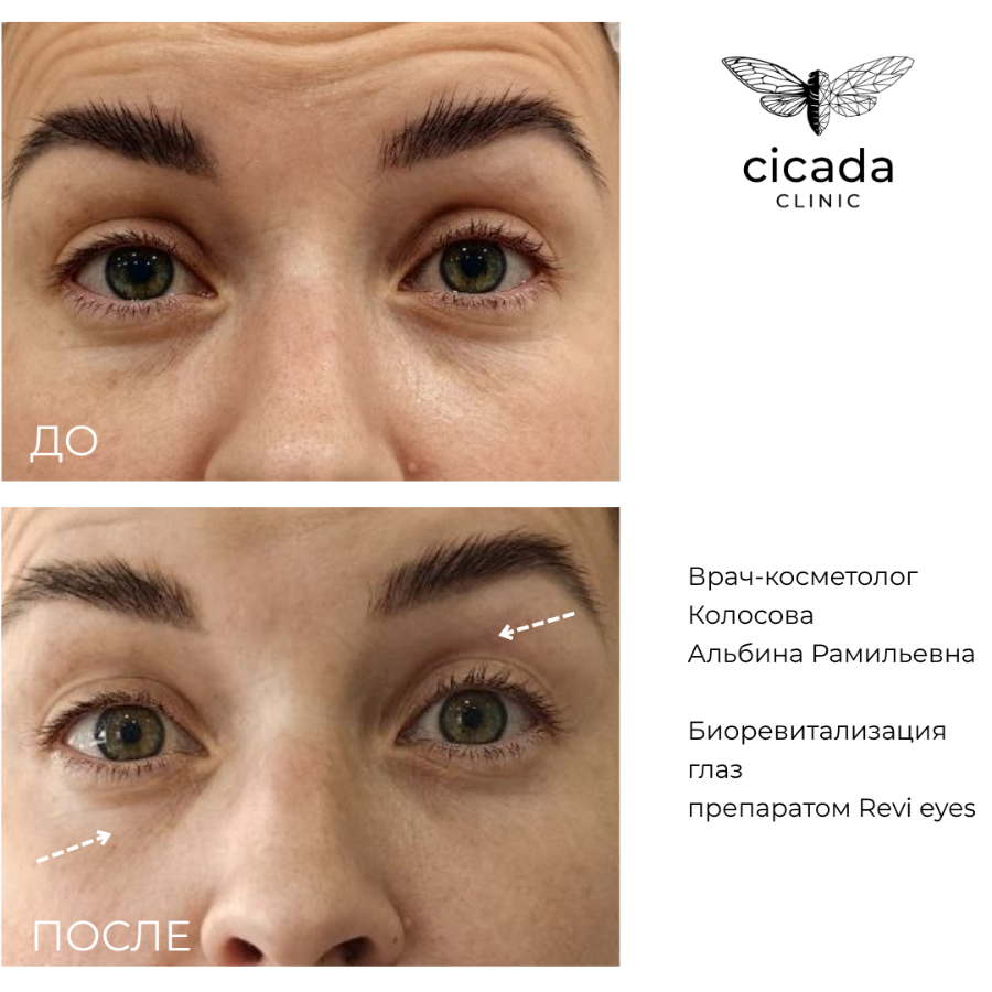 Результат процедур - Биоревитализация Цикада Клиник в Твери 