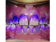 Раствор для индикации зубного налета Mira-2-Ton, Miradent, 10 мл.