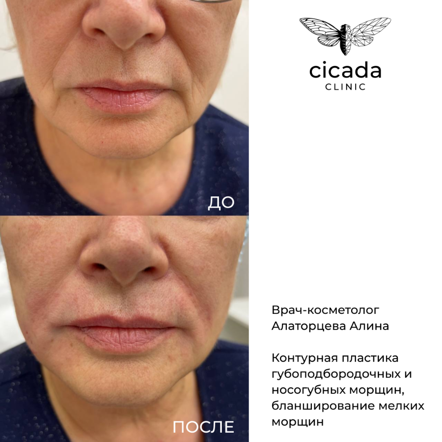 Результат процедуры - Контурная пластика лица в Cicada Clinic Тверь Цикада