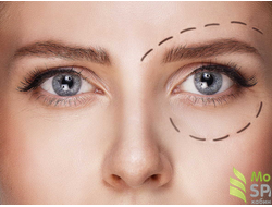 Ручная блефаропластика. 50 минут. Подробнее..