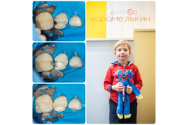 Лечение молочных зубов