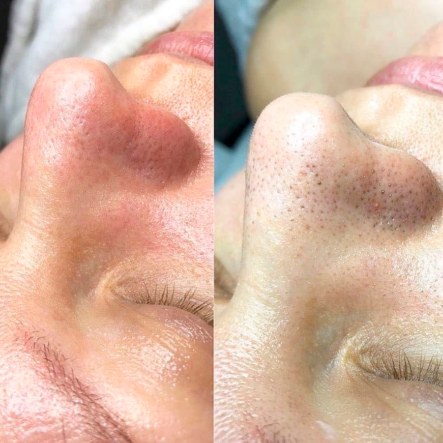 Чистка лица – база в вашем уходе за кожей