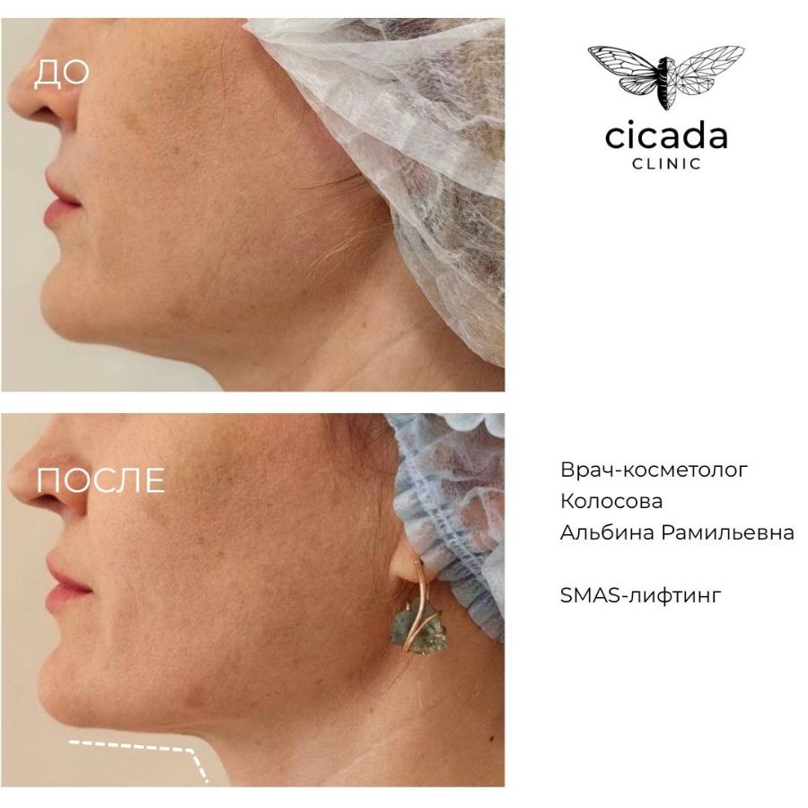 Смас лифтинг Колосова Альбина Рамильевна - Врач-косметолог cicada-clinic