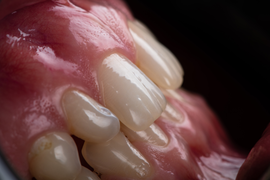 Прямая реставрация фронтальных зубов
