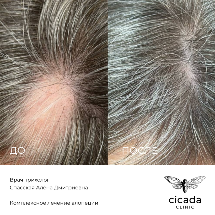 Результат процедуры - Мезотерапия волосистой части головы в Цикада Клиник Тверь