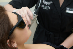 Лазерная эпиляция Кандела в Cicada Clinic