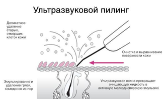 Ультразвуковой скрабер LW-006 (портативный). Глубокая очистка