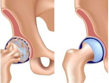 Лечение артроза тазобедренного сустава