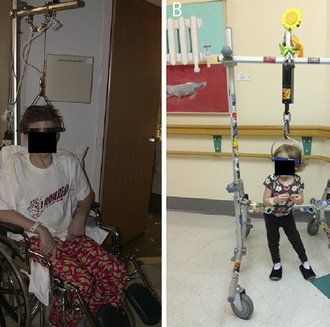 галовытяжка