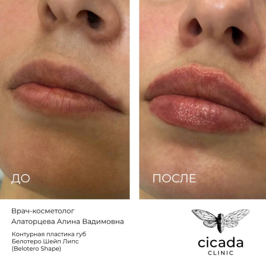 Результат процедуры - Контурная пластика губ в Cicada Clinic Тверь Цикада