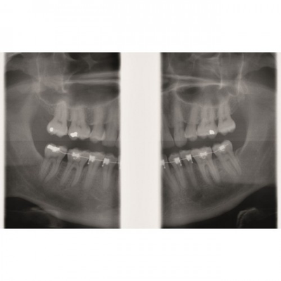 Gendex GXDP-300™ - Цифровая панорамная рентгенодиагностическая система | KAVO DENTAL (Германия)