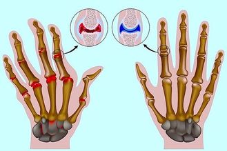 Лечение артрита кистей рук
