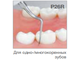 Насадка P26R пародонтологическая к ультразвуковым скалерам Varios
