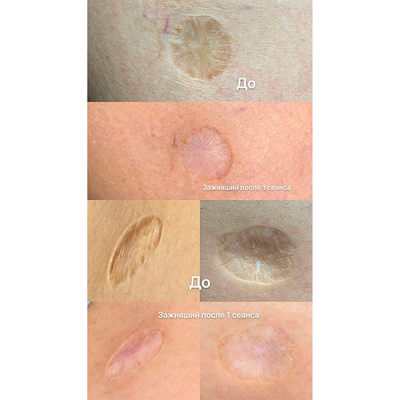 Ремувер с гликолевой кислотой 11% (GLYCOLIC ACID REMOVER) AS Company, 6 мл