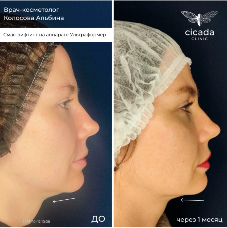 смас лифтинг результат Цикада клиник