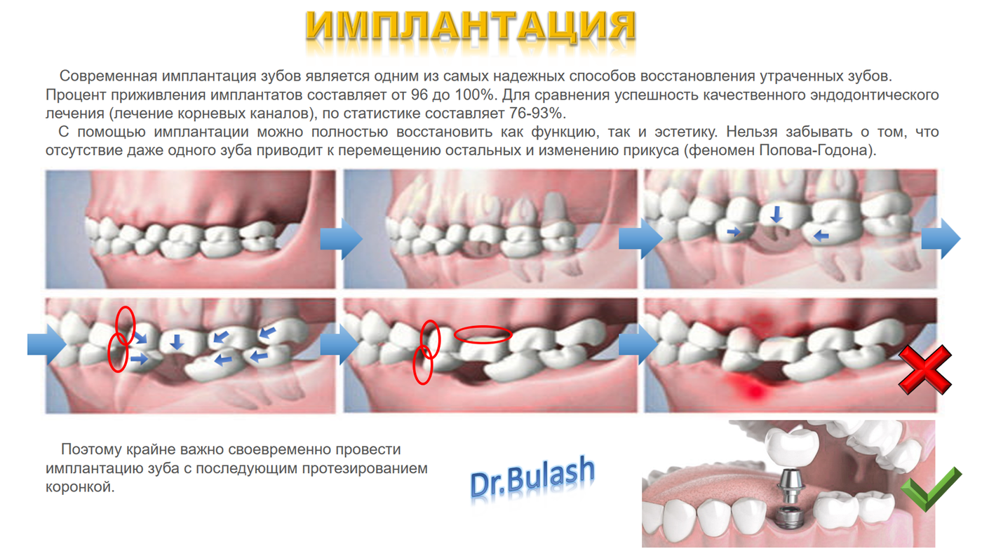 Импланты сколько болят