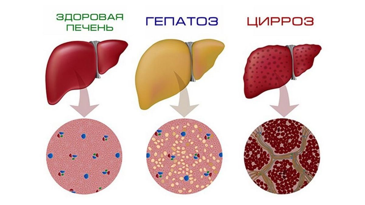 стул при жировом гепатозе печени