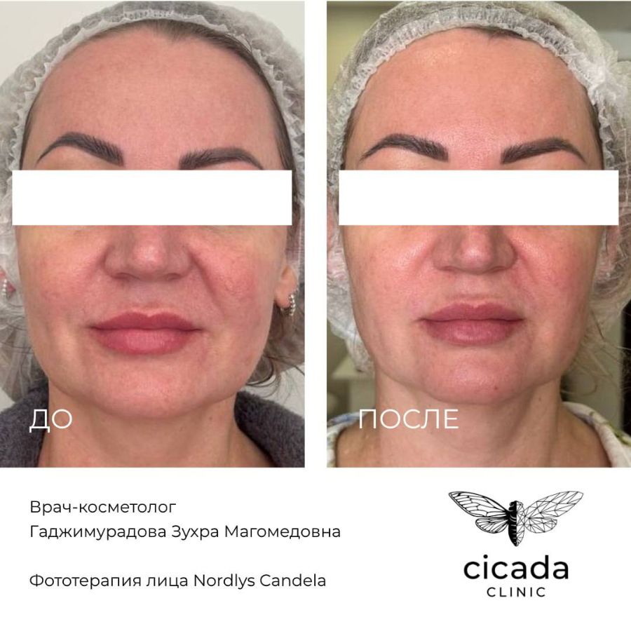 Фототерапия Гаджимурадова Зухра Магомедовна   Врач-Косметолог,  Дерматовенеролог - cicada