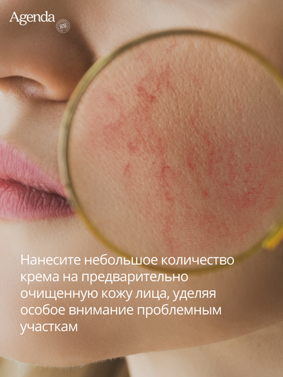 Крем антикуперозный Agenda, 50 мл