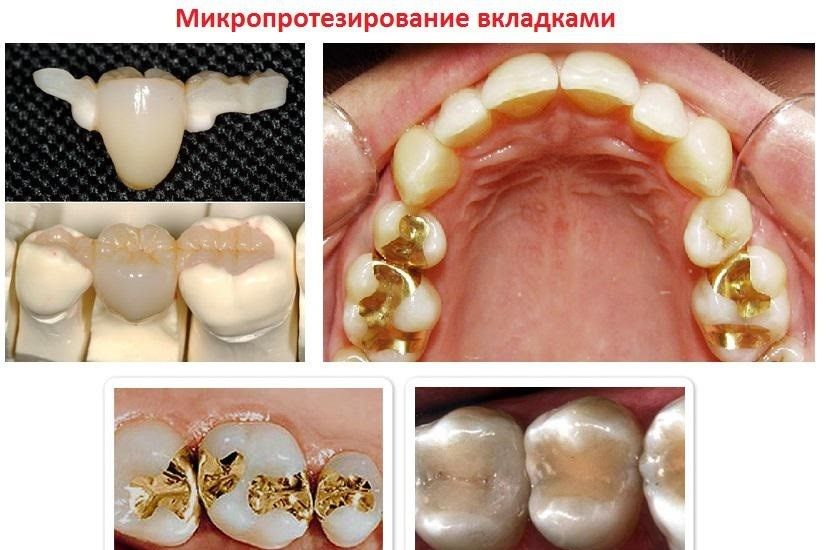 Микропротезирование зубов вкладками