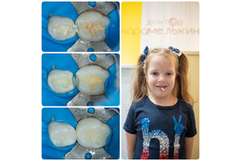 Лечение молочных зубов