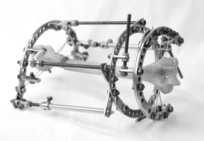 аппарат илизарова, стержень, полукольцо, удлинение конечностей, ЦИТО, РНЦ ВТО, илизаров, аппарат