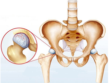 Лечение артрита тазобедренного сустава