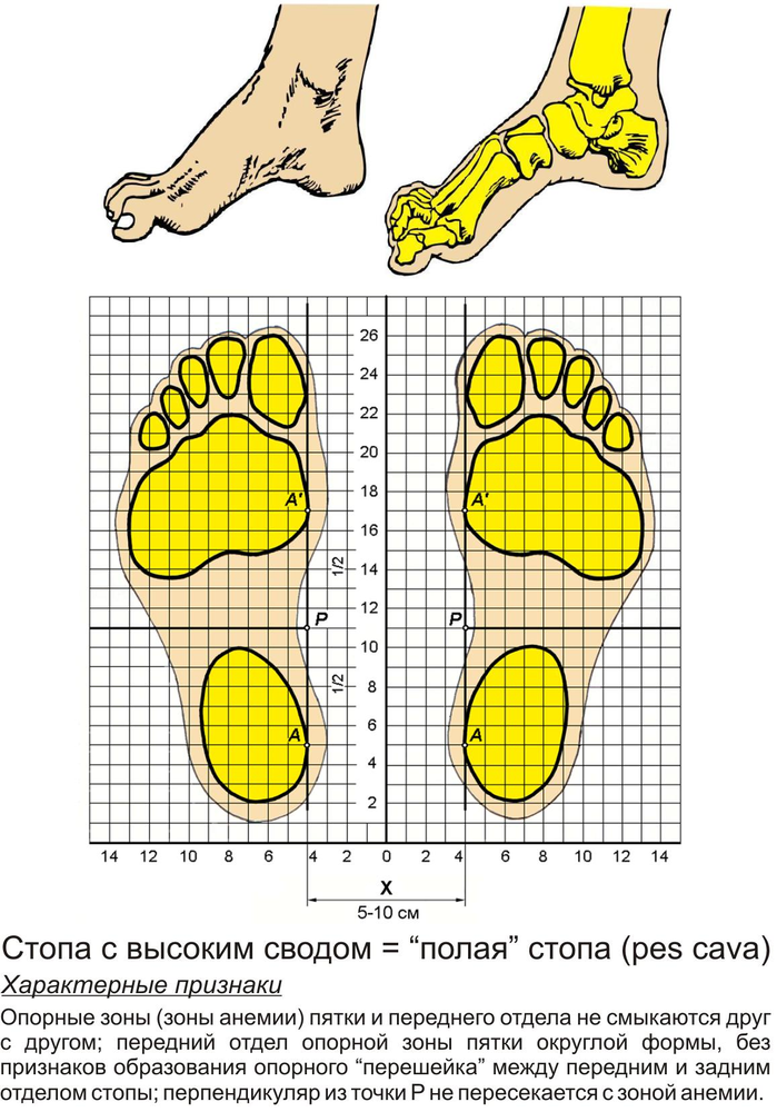 Плоскостопие схема. Продольно-поперечное плоскостопие и вальгус 3 степени. Анатомия стопы плоскостопие продольное. Сводчатая стопа и плоскостопие. Плоскостопие и полая стопа.