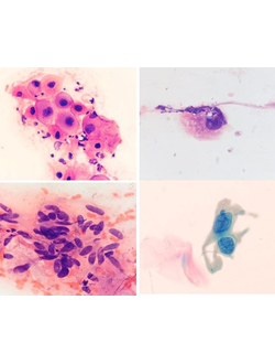 Цитопатология вульвы