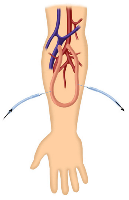 Фистула для гемодиализа на руке как выглядит Vascular Access for Hemodialysis IntechOpen